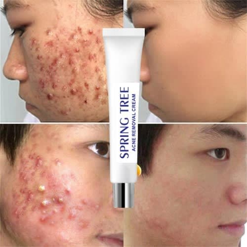 Acne/pimples Removal Cream - 30g