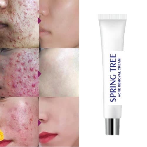 Acne/pimples Removal Cream - 30g